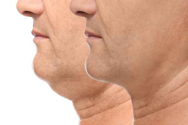 HIFU - Breakthrough in Anti - ageing 2 hifu results Northampton