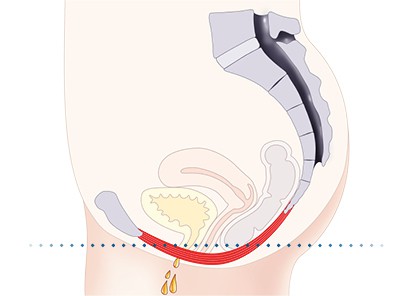 Pelvic-Floor Muscle Repair 5 Pelvic floor muscles Northampton