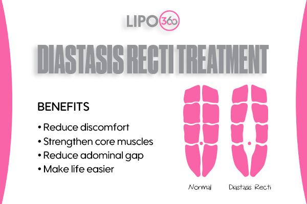 Revolutionising Muscle Repair: The Power of LIPO360 Body Sculpt Post-Injury 5 diastasis recti treatment Northampton