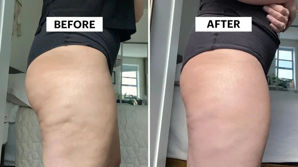 Sculpting Your Bum: Can Toning Exercises Really Reduce Cellulite? 1 Do Toning Exercise Northampton Really Tackle Cellulite?