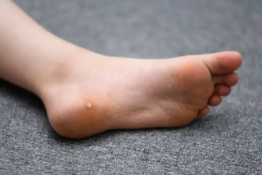 Cryotherapy For Warts And Also Verrucas 2 Image of verruca on the bottom of the foot that able to be treated with Cryotherapy Northampton