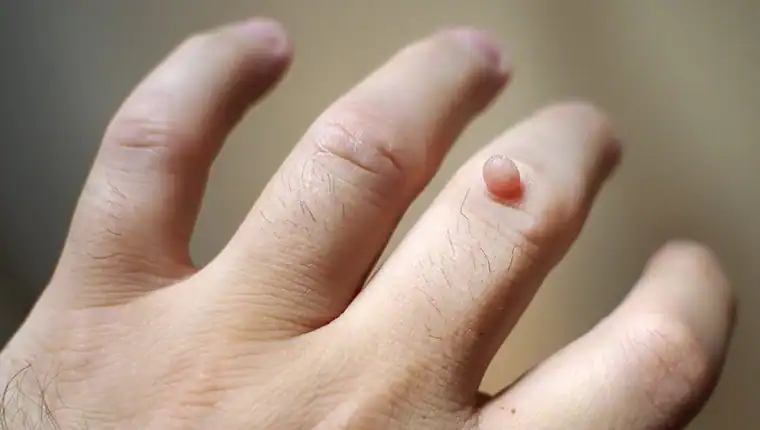 Cryotherapy For Warts And Also Verrucas 1 Image of blemish that Cryotherapy Northampton can remove with Lipo 360.