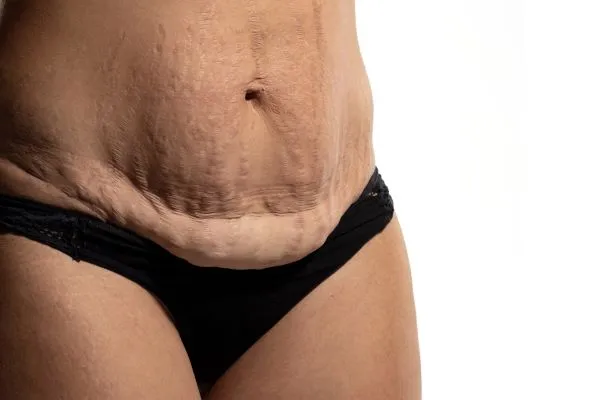 The Science of Skin Tightening 1 The science behind skin tightening Northampton picture of a woman's sagging skin on the stomach